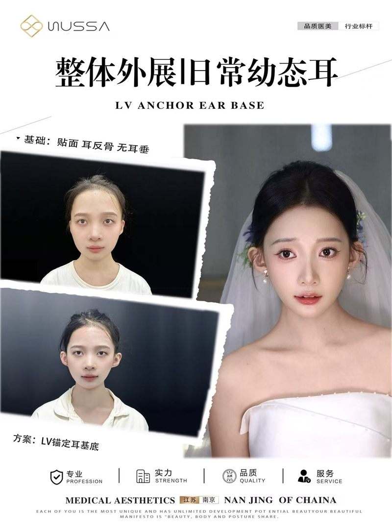 耳基底提升案例一