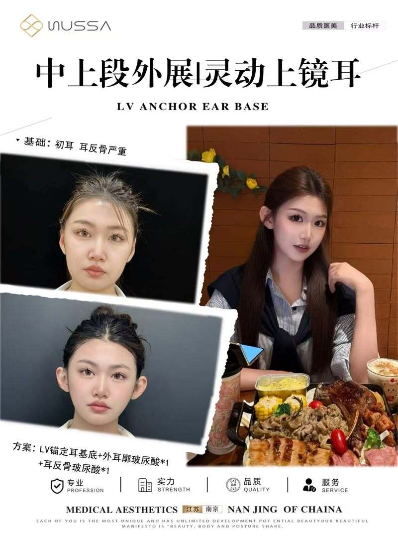 耳基底提升案例二