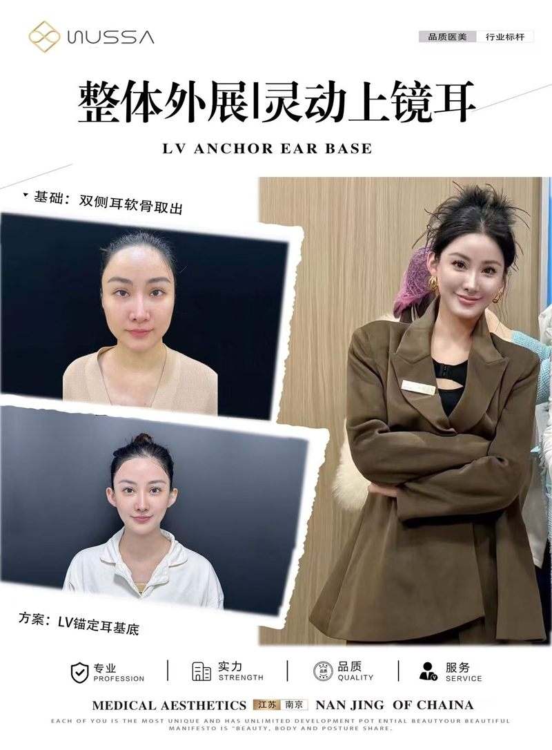 耳基底提升案例三