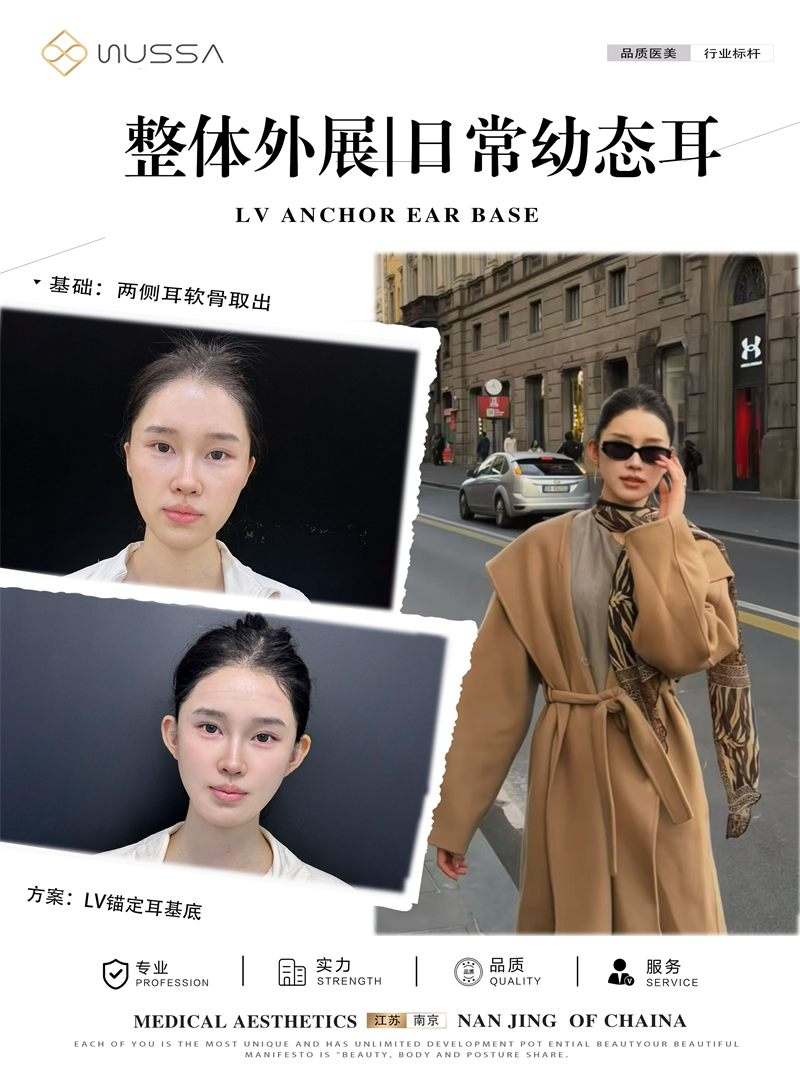 耳基底提升案例五