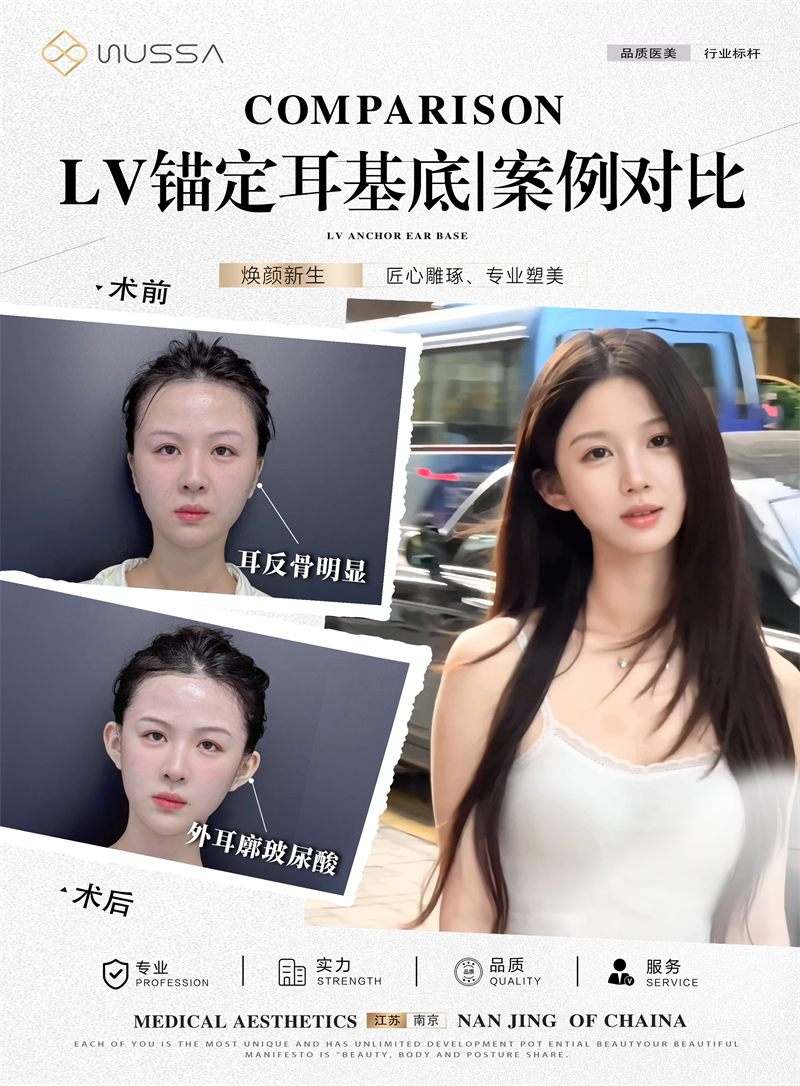 耳基底提升案例六