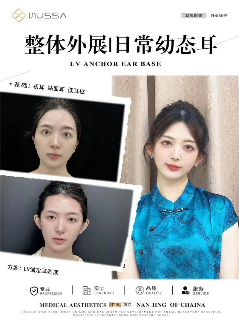 耳基底提升案例八